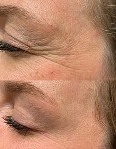 Botox Injection for Crows Feet. Botox Cosmetic Before and After. Botox Treatment In Regina