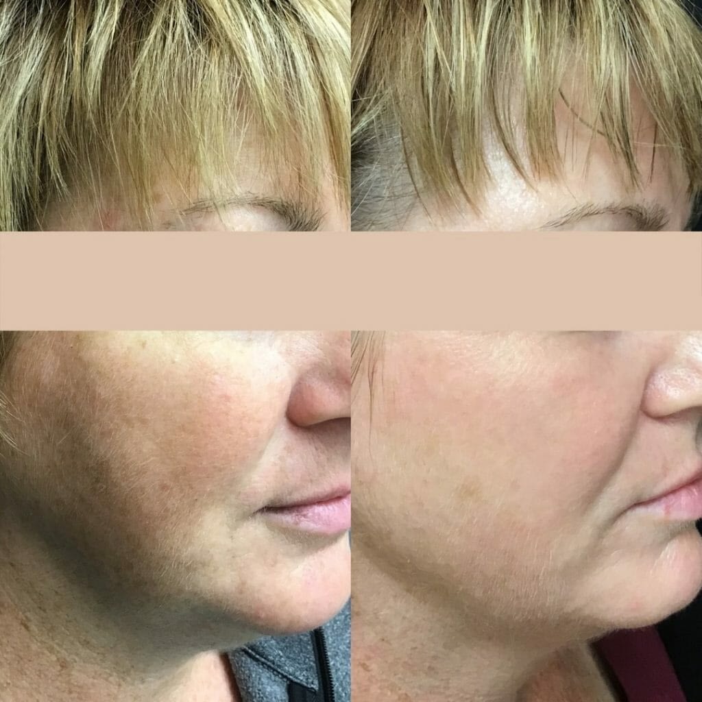 IPL-Photorejuvenation-2 IPL-Photorejuvenation-2