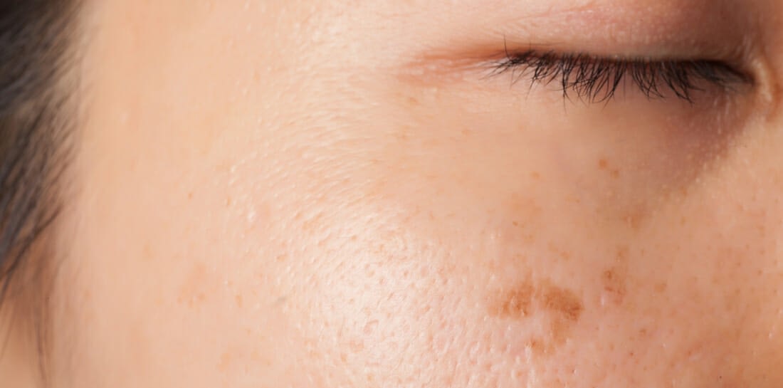 Brown Spots Taking Over Your Skin? Countdown to Hidden Damage Begins Now